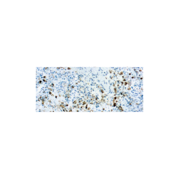 Virus del Herpes Simplex Tipo II (HSV2)
