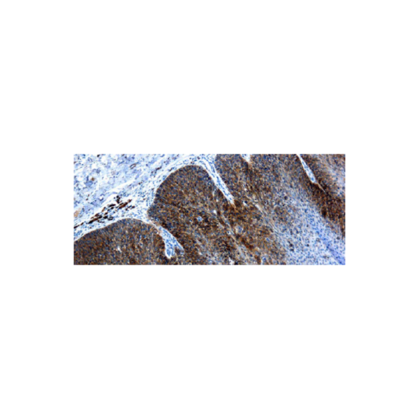 Virus del papiloma humano tipo 16, VPH 16