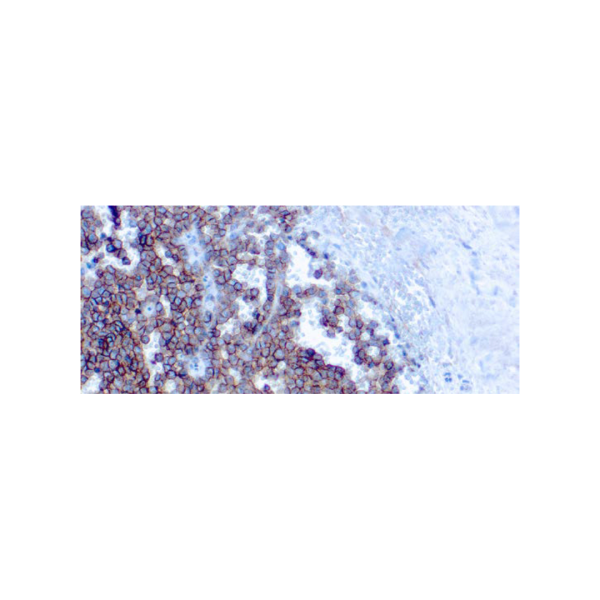 CD99MIC2, Ewing´s Sarcoma Marker