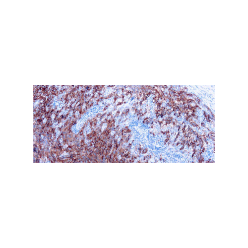 Melanoma Cocktail Antibody Melanoma Cocktail Antibody