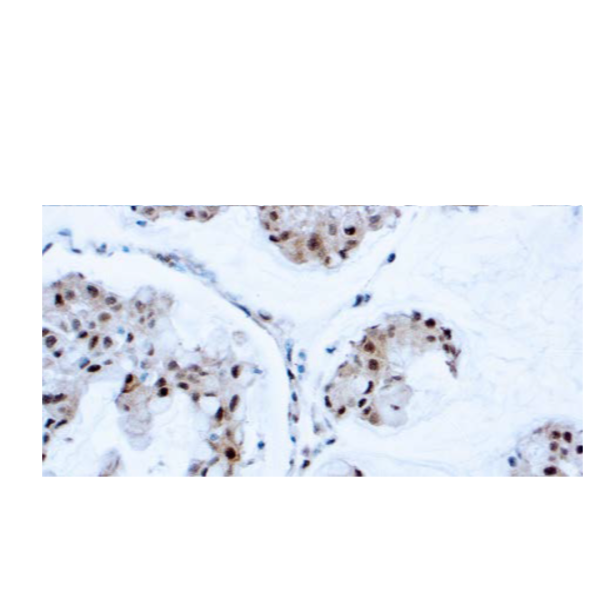 PTEN (Tumor Suppressor)