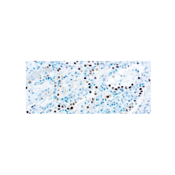 Thyroid Transcription Factor‐1, TTF‐1,