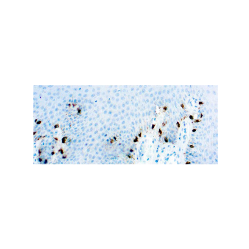 Tyrosinase, Melanoma Marker